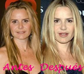 famosos cirugia estetica retoques operaciones botox